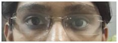 Prosthesis Eye Doctor in Rajasthan