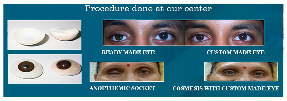 Ophthalmologist In Ahmedabad, Prosthetic Eye in Ahmedabad Ahmedabad Gujarat, Navkar Hospital Ahmedabad, Navkar Eye Hospital Ahmedabad