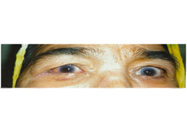 Orbit Treatment in Ahmedabad, 