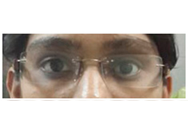 Prosthesis Eye Doctor in Rajasthan