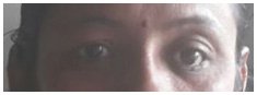 Prosthesis Eye in Ahmedabad, Best Laser Eye Surgery in Ahmedabad, Eye Number Removal Operation in Ahmedabad