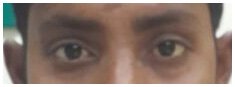 Oculoplasty Surgeon in Ahmedabad