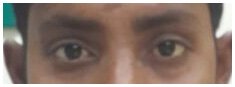 Lacrimal Treatment in Ahmedabad, Eye Specialist Doctor in Ahmedabad